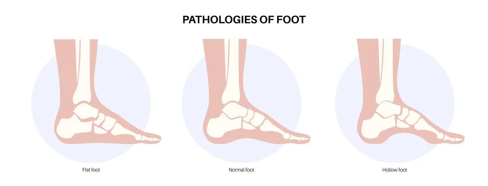 Foot pathologies poster Stockillustratie
