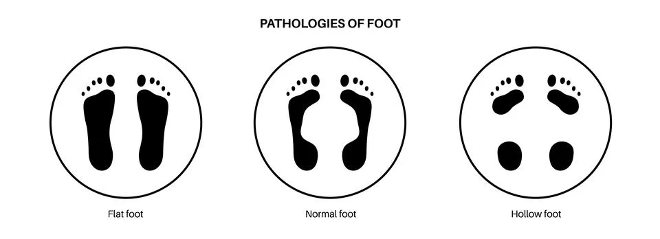 Foot pathologies poster Stock Illustration