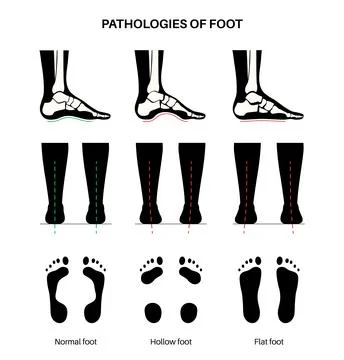 Foot pathologies poster Stock Illustration