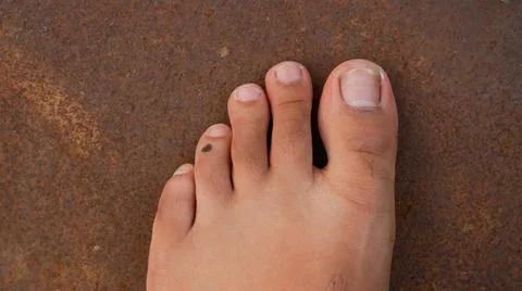 Foot with second toe equal to the big toe which is called Roman toe. Stock Photos