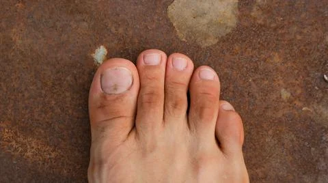 Foot with second toe longer than a big toe. Mortons's toe or Aboriginal feet. Stock Photos