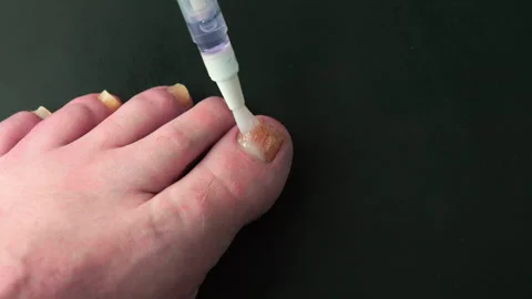 Foot shows discolored nail being treated with pen-like device for a fungal .. Stock Footage 337654281