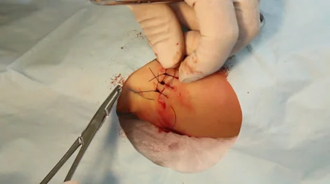 Foot surgery - stitch through double tie Stock Footage 39827437