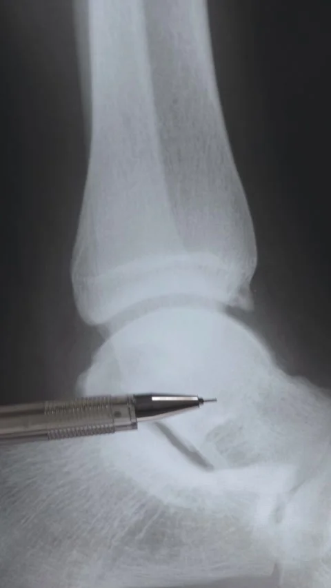 Foot trauma Vídeo Stock 321302847