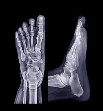 Foot x-ray image AP and Lateral view  isolated on black background. Stock Illustration
