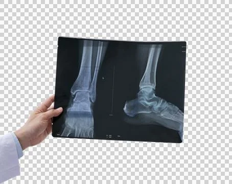Foot X ray image with hand pointing by pen PNG Stockfoto's