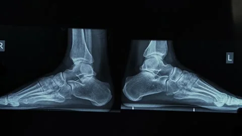 Foot X Ray Image Placed on Medical Viewing Board Stockbeeldmateriaal 340666933