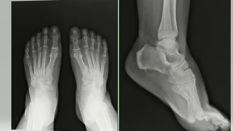 Foot X-rays in direct and side projection 库存影片 111647604