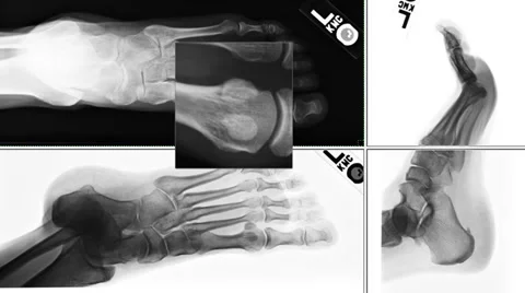 Foot X-rays reviewed for diagnosis. Vidéo 37068864