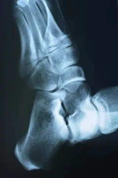 Foot xray Foto stock