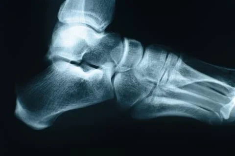 Foot xray Stock Photos