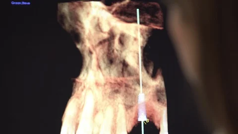 Footage of 3D x-ray software being used to plan dental implant Stock Footage 113758174