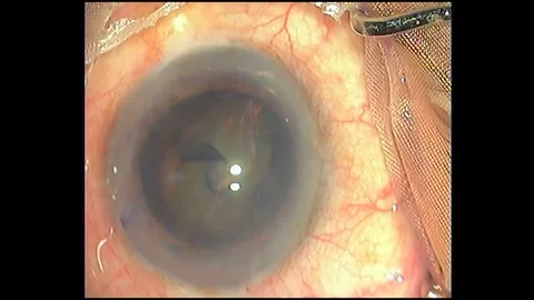 Footage of cataract surgery for human eye by using PACO procedure Stock Footage 283930615