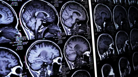 Footage of CT brain with paning camera Video stock 148621683