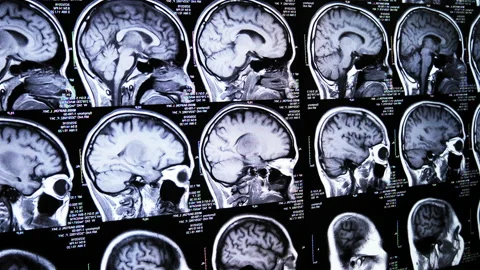 Footage of CT brain with paning camera Video stock 148636965