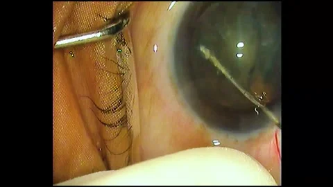 Footage of Phacoemulsification Cataract surgery Stock Footage 284506623