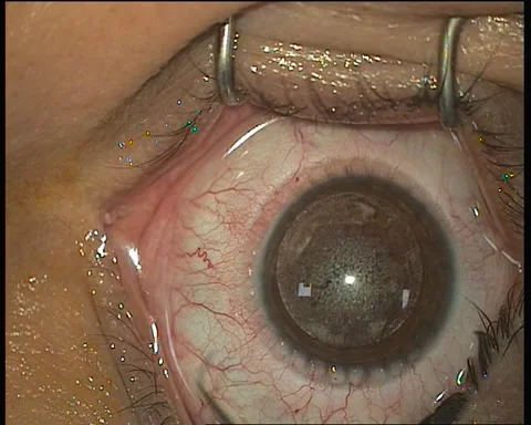 Footage of separating corneal flap by flap lifter after femtosecond keratome Stock Footage 284316633