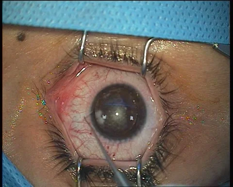 Footage of separating corneal flap by flap lifter after femtosecond keratome Video stock 284317722