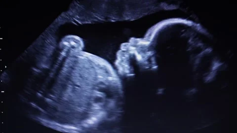 Footage Ultrasonography of third trimester pregnancy. Stock Footage