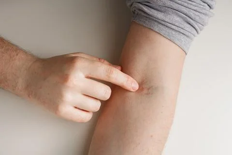 Forefinger points on vein injection mark on arm. Bruising, redness Stock Photos