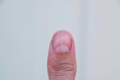 Forked nail on the thumb. Dilation of the nail, traumatic pathology. The na.. Stock Photos
