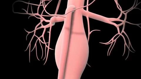 Formation of abdominal aortic aneurysm Stock Illustration