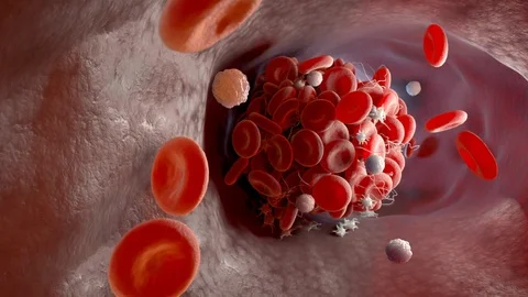 Formation of a blood clot Stock Footage