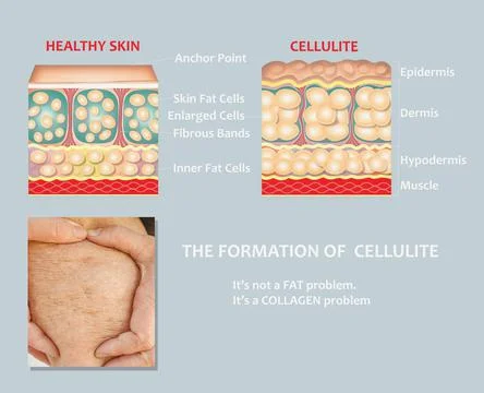 Forming of underskin cellulite illustration Stock Illustration