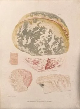 Four sections of diseased brain; and a section of spine. Colour stipple etc.. Stock Illustration