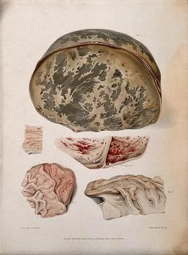 Four sections of diseased brain; and a section of spine. Coloured stipple e.. Stock Illustration