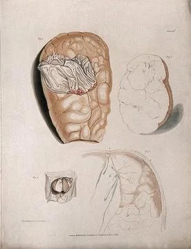 Four sections of diseased brain. Colour stipple etching by C. J. Canton for.. Stock Illustration