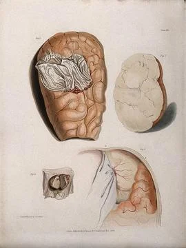 Four sections of diseased brain. Coloured stipple etching by C. J. Canton f.. Stock Illustration