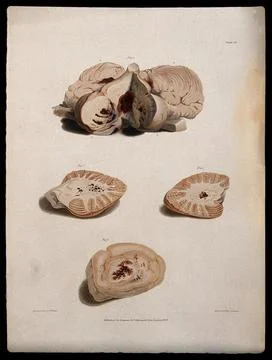 Four sections of diseased brain. Coloured stipple etching by C. J. Canton a.. Stock Illustration