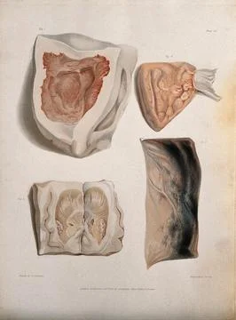 Four sections of diseased brain. Coloured stipple etching by W. T. Fry afte.. Stock Illustration