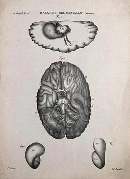 Four sections of diseased brain, numbered for key. Lithograph by Batelli af.. Stock Illustration