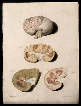 Four sections of diseased kidney. Colour aquatint by W. Say after F. R. Say.. Stock Illustration