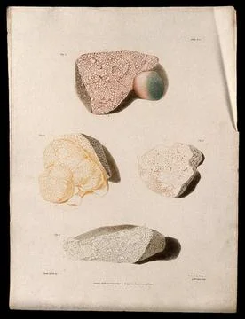 Four sections of diseased liver. Colour aquatint by W. Say after F. R. Say .. Stock Illustration