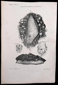 Four sections of diseased placenta, numbered for key. Lithograph by Ridolfi.. Stock Illustration