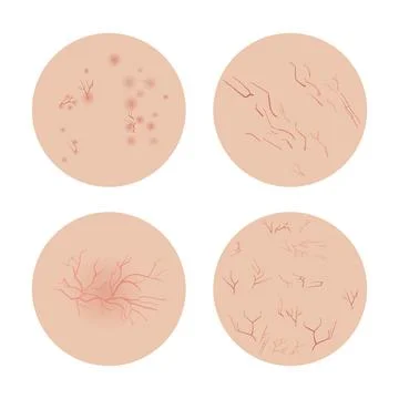 Four Types of Rosacea Showing Different Symptoms on Skin Illustrazione stock