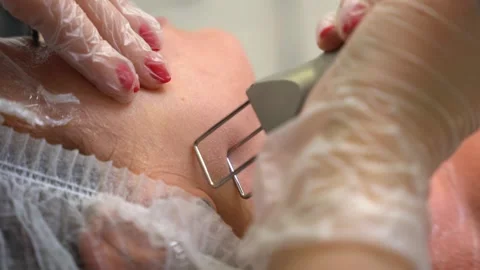 Fractional CO2 laser skin resurfacing procedure on female face professional Stock Footage 334732709