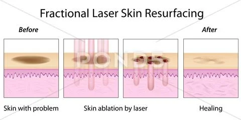 Fractional Laser Skin Resurfacing Stock Illustration
