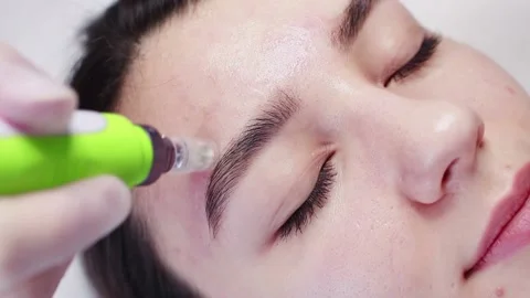 Fractional mesotherapy. Stock Footage 134773739