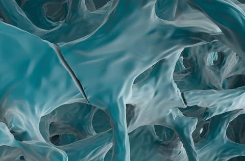 Fracture bones in osteoporosis Illustrazione stock