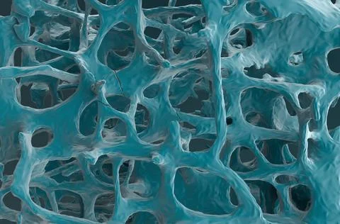 Fracture bones in osteoporosis Ilustração Stock