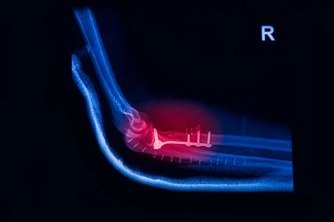 Fracture elbow, forearm x-rays image showing plate and screw fixation Stock Photos