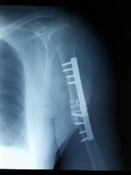 Fracture fixation after surgery of broken arm bone Stock Photos