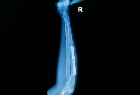 Fracture forearm with  internal fixed by plate and screw Stock Photos