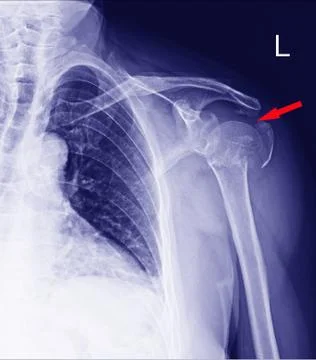Fracture neck humerus. Stock Photos