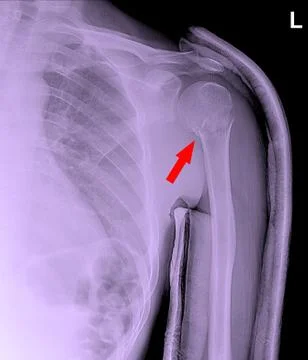 Fracture neck humerus. Stock Photos