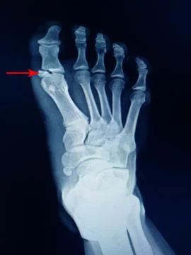 Fracture proximal phalang Stock Photos